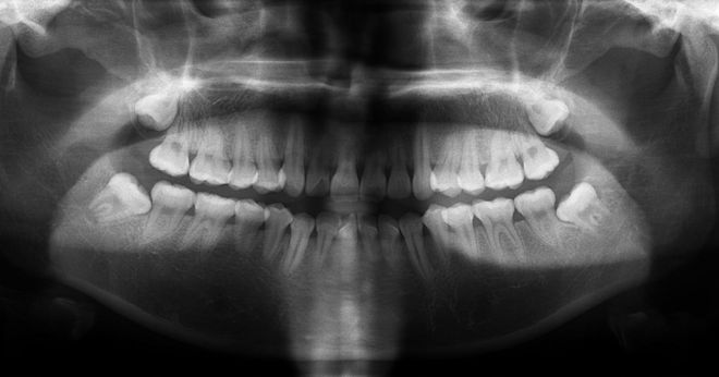 最新拔智齿技术，革新口腔健康新篇章